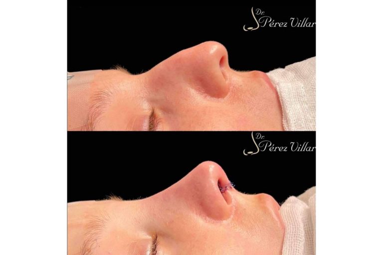 Dr. Álvaro Pérez-Villar Bonet indica por qué la rinoplastia ultrasónica de preservación es una técnica cada vez más presente en el mundo de la estética