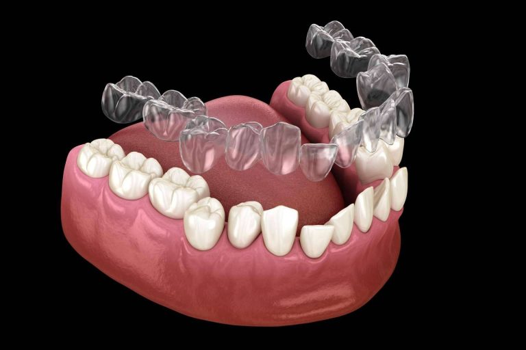 Tratamientos de ortodoncia invisible en Valencia, de la mano de la Clínica Dental Bucalia