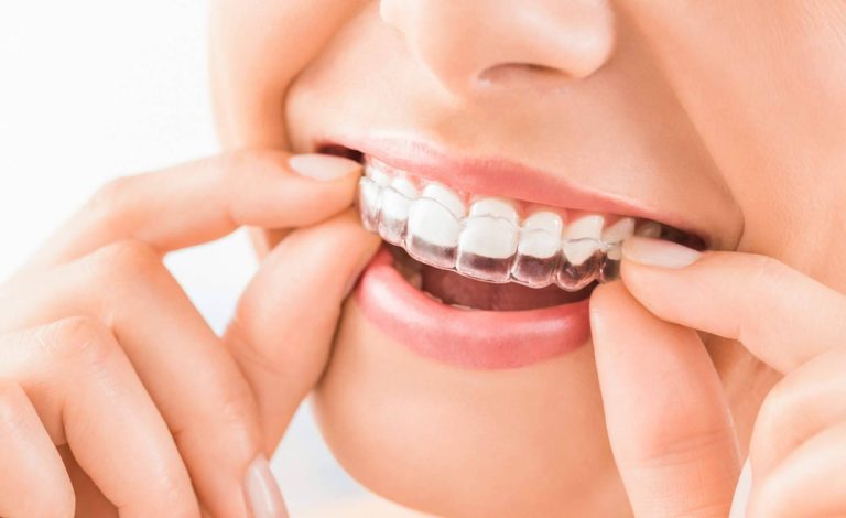 Los beneficios de la ortodoncia invisible Invisalign, con InterORALIA