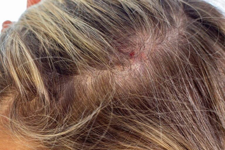Dermatitis seborreica, una afección que puede provocar alopecia si no se trata