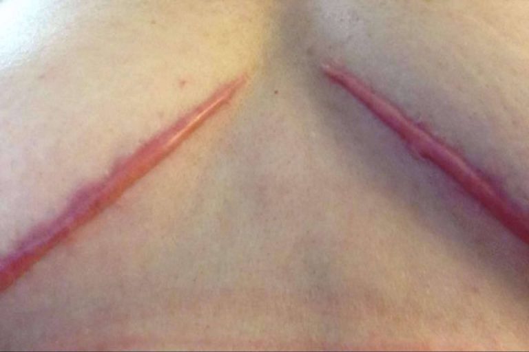 ¿Cómo reducir las cicatrices tras una operación?, por Capenergy