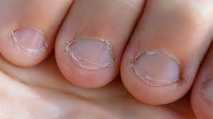 ¿Qué tipo de problemas puede ocasionar comerte las uñas?