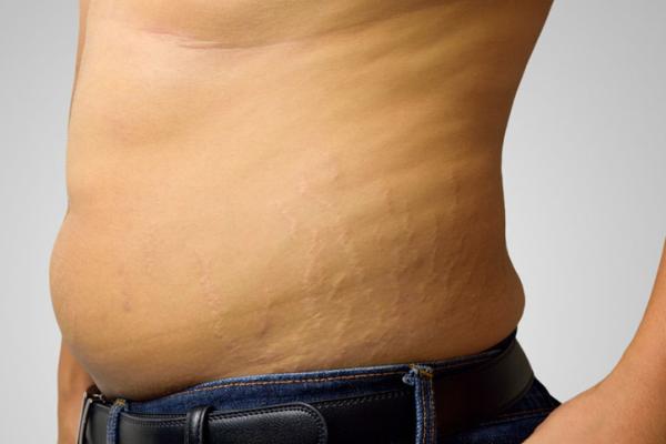 No las sufren exclusivamente las mujeres