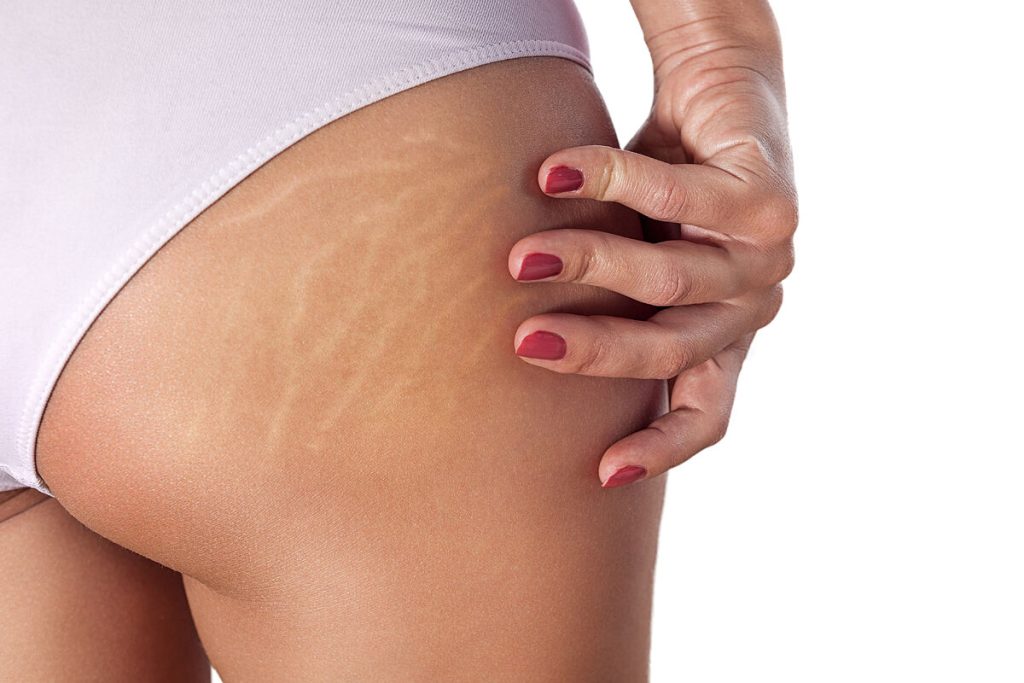 ¿Cómo son las estrías y en dónde aparecen?