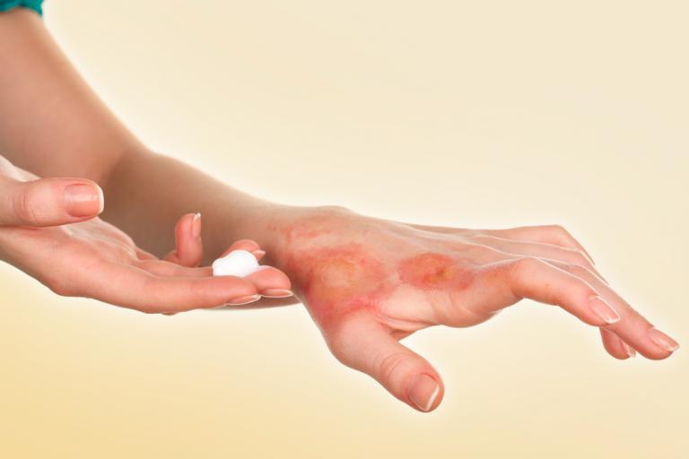 ¿Qué pasa cuando exponemos la piel a calores extremos?