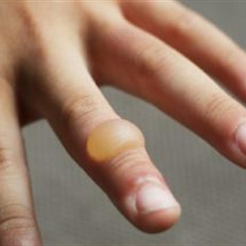 ¿Cómo se clasifican las quemaduras?