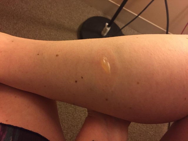 ¿Cómo se trata una quemadura de tercer grado?