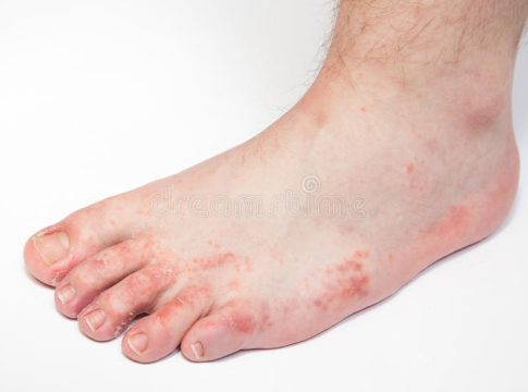 Qué es el pie de atleta 1 Qué es el pie de atleta