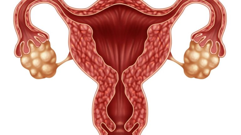 Qué son los ovarios poliquísticos