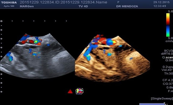 ¿Hay complicaciones asociadas con el síndrome de ovarios poliquísticos?