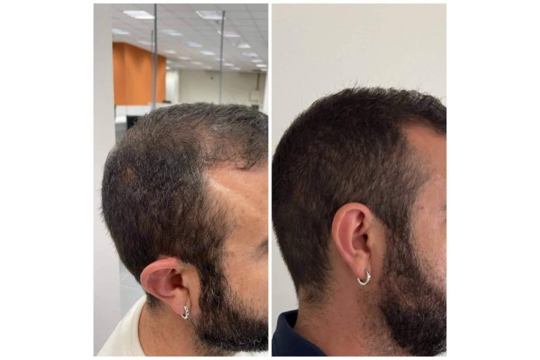 Los tratamientos de Cecilia Arthur para la caída de pelo