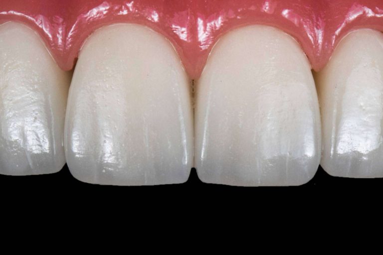 Corporación Dental pone implantes de carga inmediata en Antequera