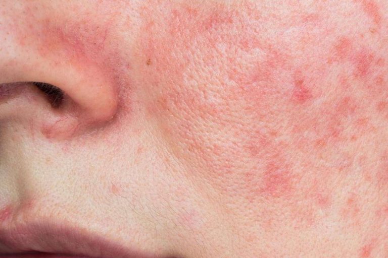 Información sobre la rosácea y cómo eliminarla
