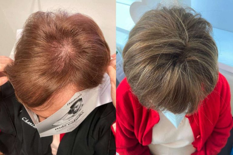 Mar Chancosa coloca extensiones de cabello 100% de cabello natural de Hairdreams