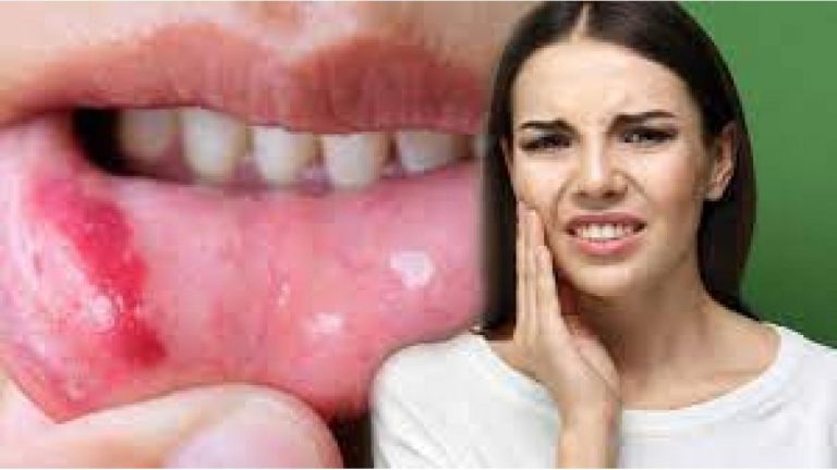 Remedios caseros para olvidarte de las vejigas y llagas en la boca