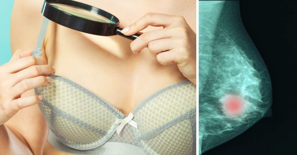 Cáncer de mama: síntomas y señales de alerta a tener en cuenta 162 masas en los senos