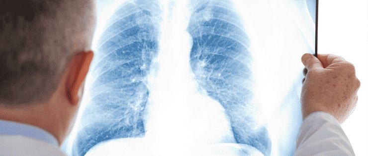 Pulmonía en ancianos: todo lo que debes saber