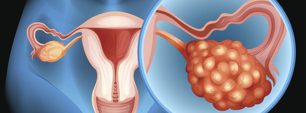 Causas del cáncer de ovarios