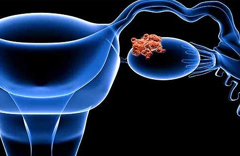 Cancer de ovarios sintomas Cancer de ovario