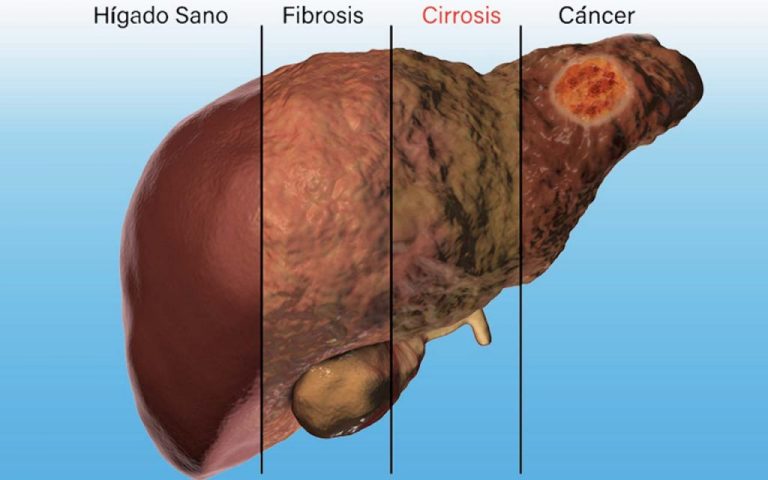 Cáncer de hígado: síntomas que te avisan del problema