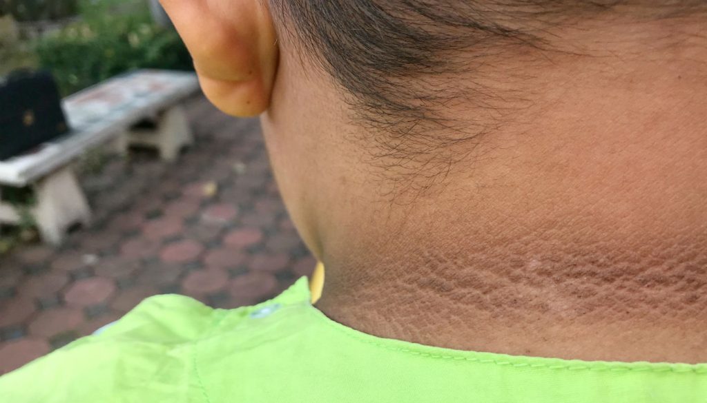 Aparición de manchas oscuras en la piel