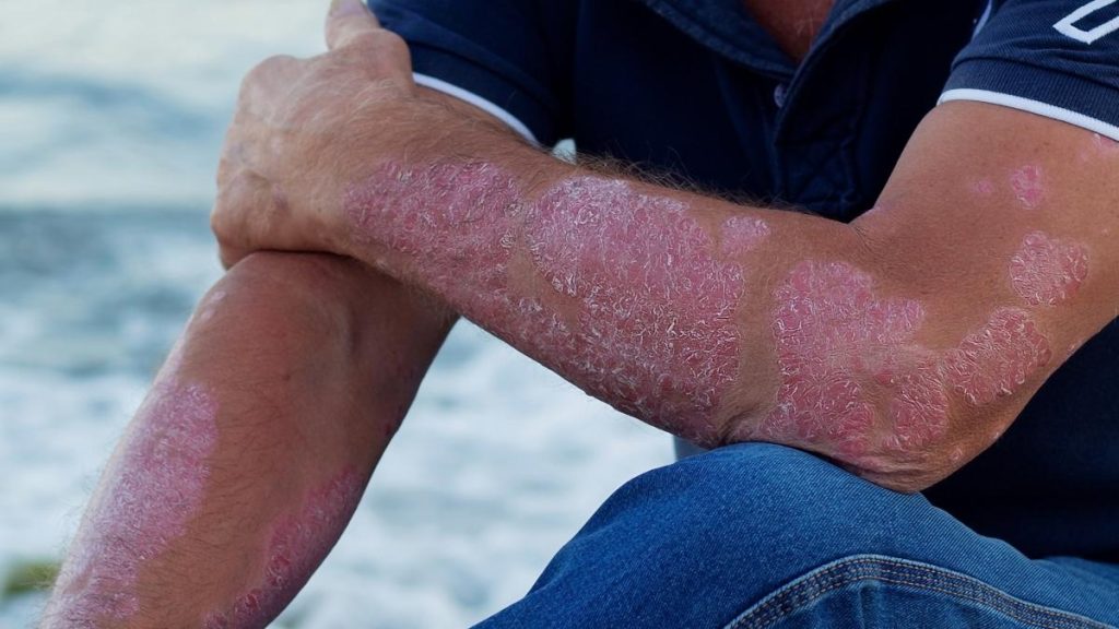 Psoriasis y acné: afecciones que mejoran con el sol 
