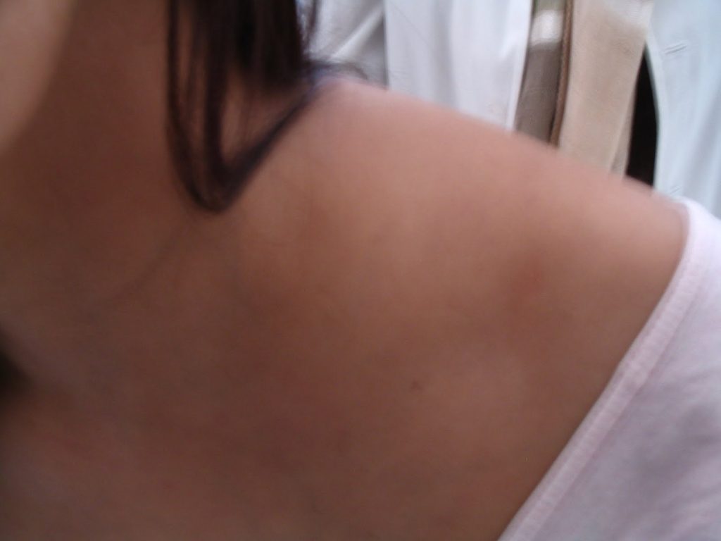 Qué es la adenopatía 2 ¿Cuáles son sus síntomas?