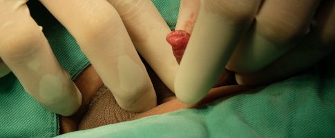 Qué es la fimosis 1 Qué es la fimosis