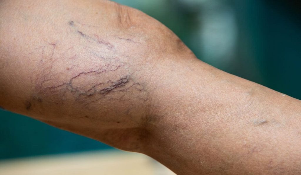 Várices por cruzar las piernas al sentarse