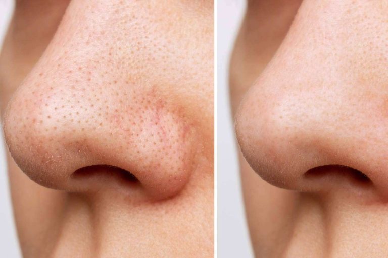 Tratar los puntos negros con los productos efectivos de JK Natural Care