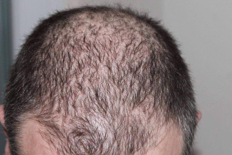 Un arma eficaz contra la alopecia androgenética, la mesoterapia capilar con antiandrógenos