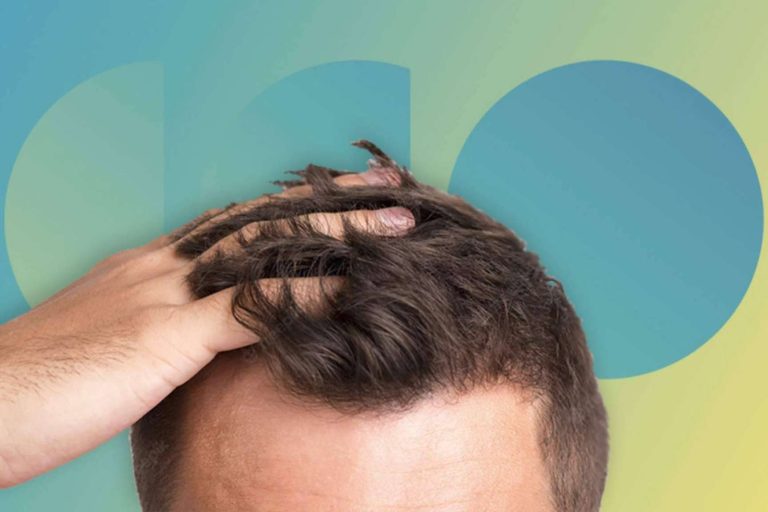 ¿Por qué la caída de cabello estacional viene más fuerte este año?