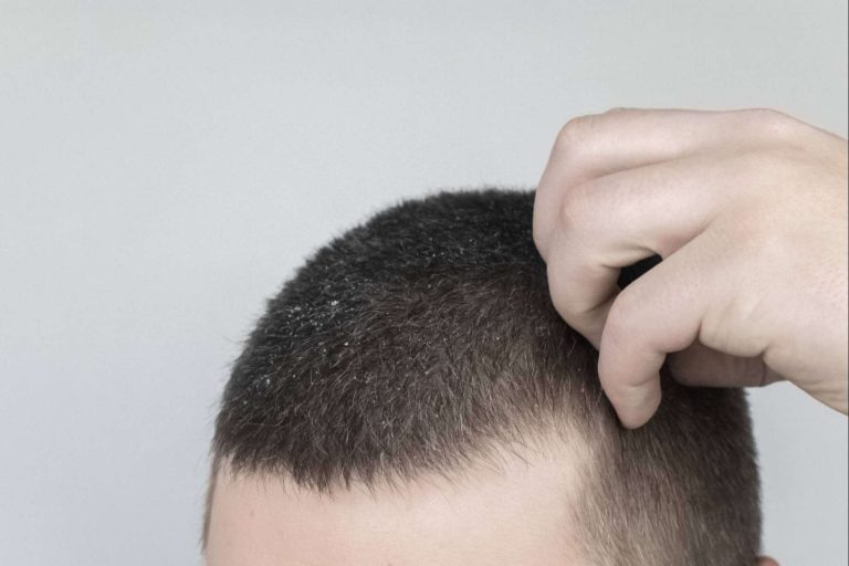 La caspa, ¿culpable de la caída del cabello?