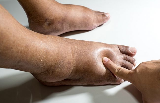 Síntomas que te avisan de que los riñones no te funcionan bien 140 Mal funcionamiento de riñones por piernas hinchadas