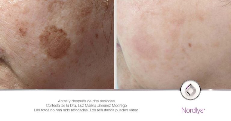 La Dra. Luz Marina explica el tratamiento antiedad sin bisturí que ya aplica en su clínica de Soria