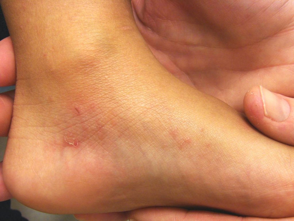 Sarna en España sus síntomas y cómo evitarla