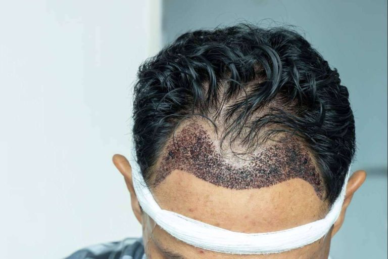 El éxito de un injerto capilar depende de su buen diseño, por MC360