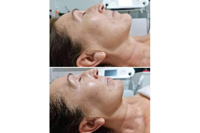 Mar Chancosa y su servicio de radiofrecuencia INDIBA