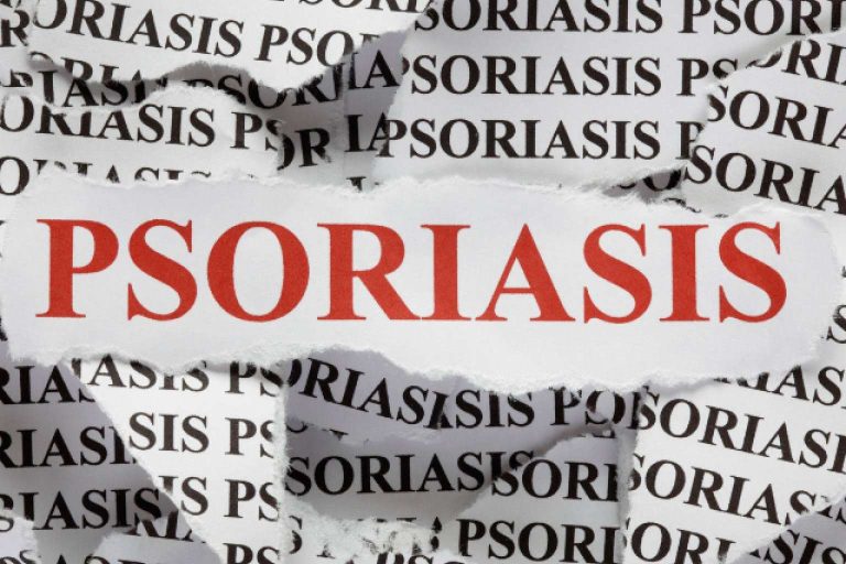 Psoriasis desde la naturopatía