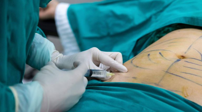 ¿Cuáles son las ventajas de la lipoescultura?, con A2Clínic
