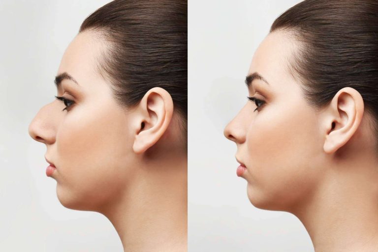 Dr. Jorge Planas, experto en la rinoplastia ultrasónica en Madrid