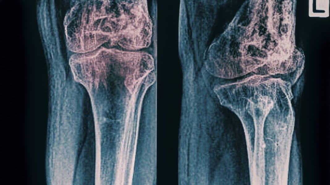 El inesperado uso médico de los mocos que entusiasma a los científicos