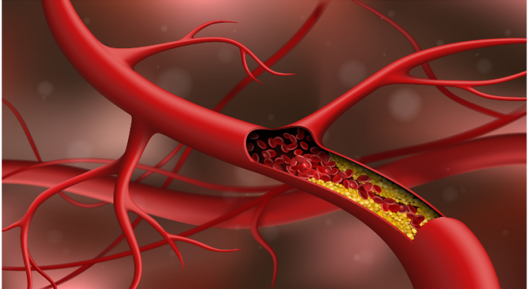 Cómo reducir el colesterol sin necesidad de hacer dieta