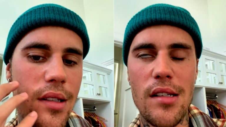 ¿Qué es el síndrome de Ramsay Hunt?.