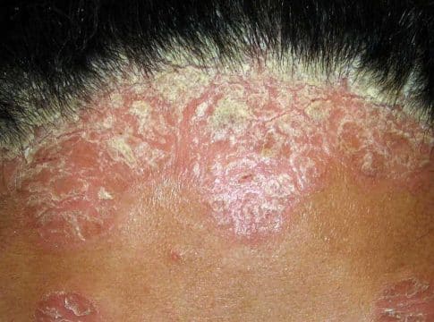 Qué es la soriasis 2 Qué es la soriasis