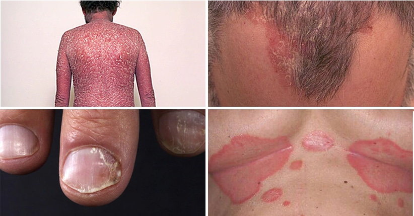 Qué es la soriasis 1 La soriasis se manifiesta en brotes