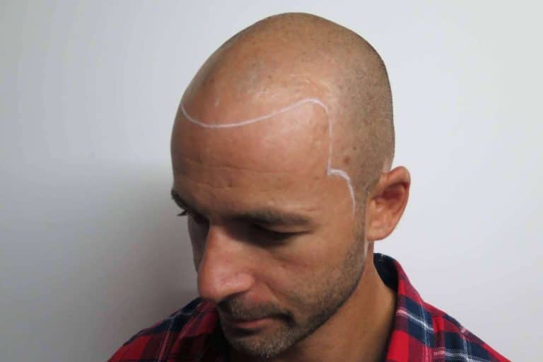 La experiencia y calidad que Aldemar Campos ofrece a sus clientes en la micropigmentación capilar