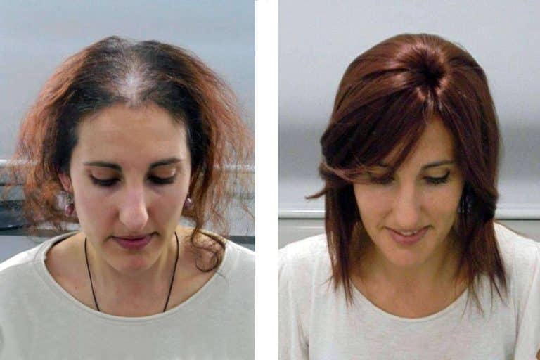 En IMD cuentan con los Sistemas de Integración Capilar como solución estética a la falta de densidad capilar