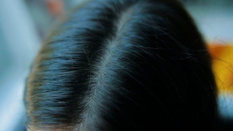 ¿Qué es la tiña y qué efectos tiene?