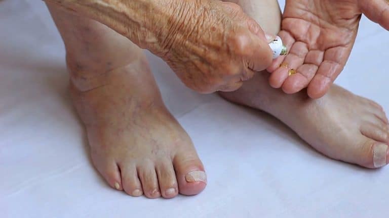 Anoniquia: vivir sin uñas en manos y pies